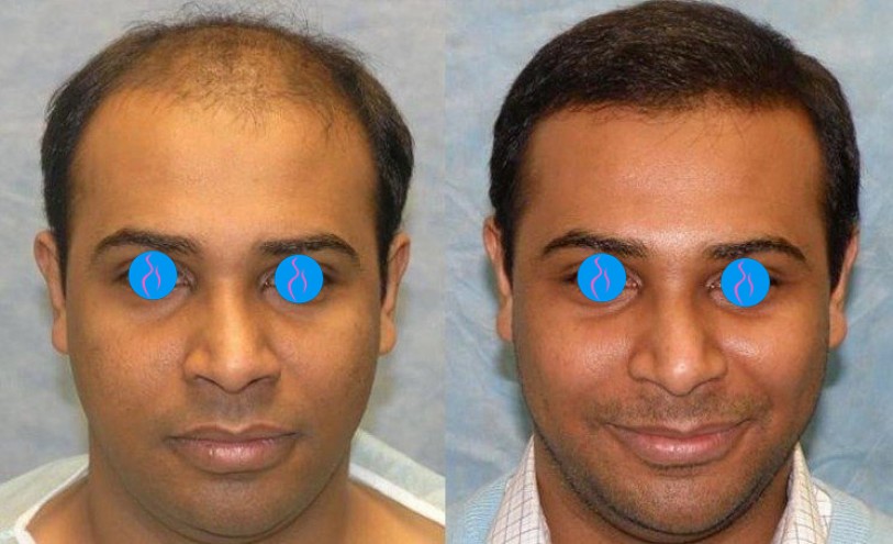 Best & Affordable Hair Transplant At Blue Venus Plastic Surgery Raipur