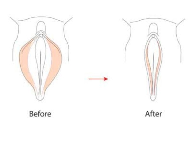 Labiaplasty
