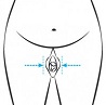 Labiaplasty